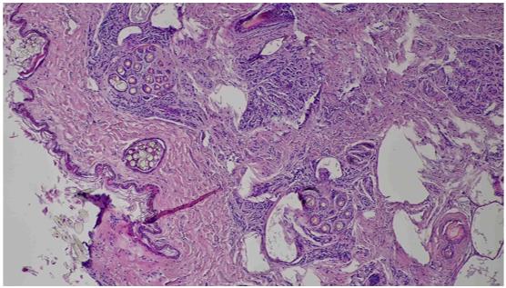 The microphotographs of the male specimen of the inguinal gland. The view of the branched
       structure of the sebaceous glands, its’ excretory ducts, the secret that concentrates in the
       ducts, the hair sheath and excretes out of the hair follicles