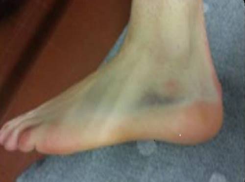 Ankle left - side view, J. B.