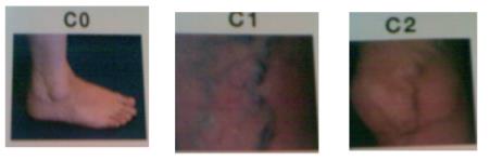 C0 - there are no visible or palpable signs, C1 – telangiectasia or venules, C2 varicose veins 