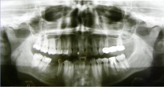 Ortopantomography – selective clinical cases from Dental clinic Based “M. Kogalniceanu” Iași