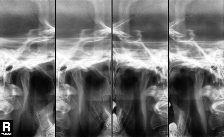 ATM tomography – selective clinical cases from Dental clinic Based “M. Kogalniceanu” Iași]