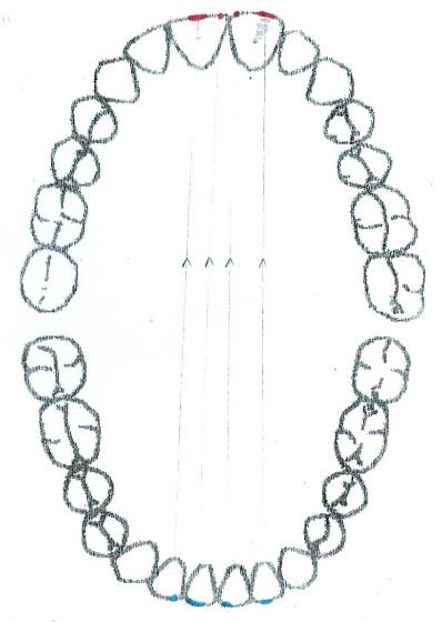 Dynamic occlusion protrusion – selective clinical cases from Dental clinic Based “M. Kogalniceanu” Iași