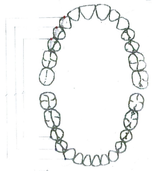 Dynamic occlusion laterality right– selective clinical cases from Dental clinic Based “M. Kogalniceanu” Iași