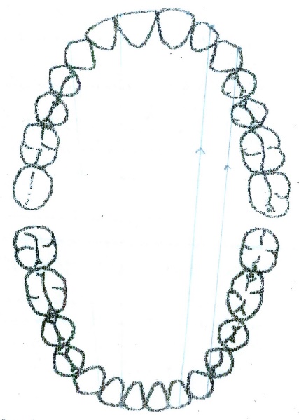 Dynamic occlusion laterality left – selective clinical cases from Dental clinic Based “M. Kogalniceanu” Iași