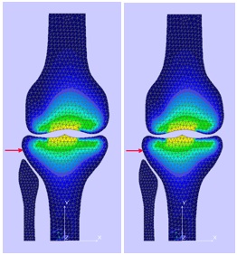 The mechanical stresses map in a mathematical model subjected to a traumatic agent acting
       at a speed of 20km/h (left) and 40km/h (right)]