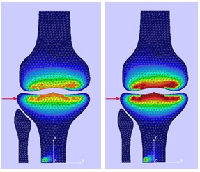 Mathematical model broken and shearing in key points of tetrahedron all tibial plateau and
       femoral condyle, without comminuted (left) and with comminuted (right)