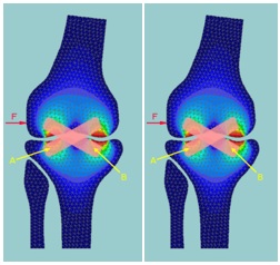 Mathematical model of the knee positioning cross ligaments with their inserts A and B; an
       external force F is applied on the lateral side of the knee