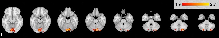 Patterns of activation for right-handers > left-handers contrast