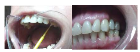 Intraoral aspects of the adhesive bridge 