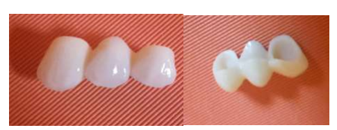 Aspects of ceramic on zirconia bridge