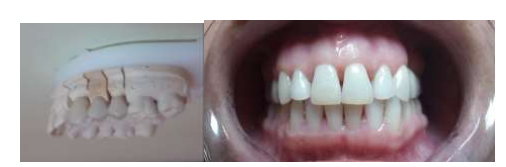 Aspects of ceramic on zirconia bridge on model and intraoral