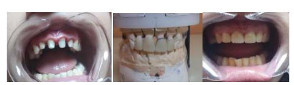 Aspects of non-metallic fixed restauration ceramic on zirconia 