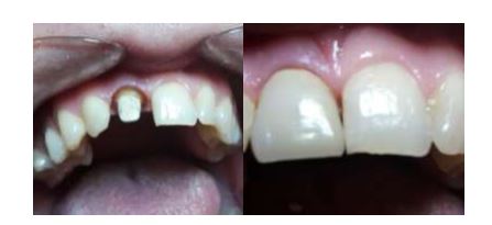 Aspects of rehabilitation of single teeth using ceramic on zirconia crown 
