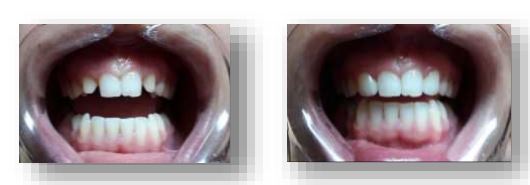 Aspects of rehabilitation of lateral anodontia using all-ceramic crowns 