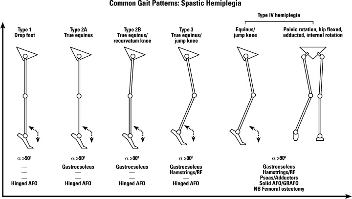 Classification of gait patterns in spastic hemiplegia (according to Rodda and Graham, 2001)