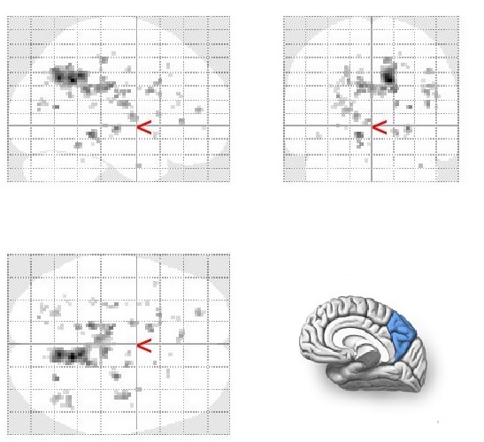 Patterns of activation for Stroop 2 > Stroop 1 (right precuneus)