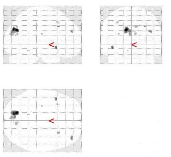 Pattern of activation for Stroop 2 > Stop-signal (left precuneus)