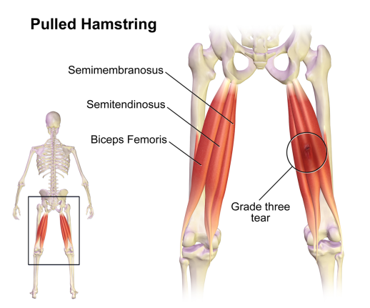 Semimembranosus Hamstring Muscle, Source: https://www.dovemed.com/diseases-conditions/hamstring-muscle-injuries/